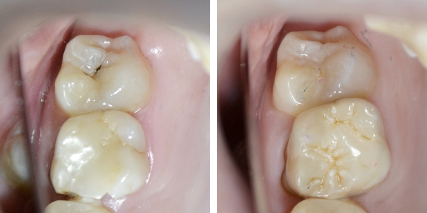 реставрация зуба композитным материалом.png